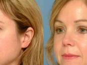 Brow Lift (Forehead Lift) Surgery Magic Look Younger