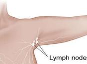 Lymphedema After Breast Reconstruction