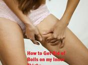 Boils Inner Thighs: Home Remedies