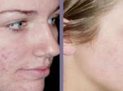 Chemical Peel Facts, Benefits Side Effects