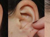 Perfectly Shaped Ears with Lobe Surgery