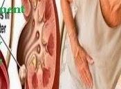 Natural Kidney Stone Treatment That Really Works