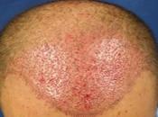 Regain Hair Volume with Transplant Surgery