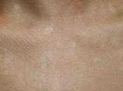 Easy Ways Cure White Spots from Tanning