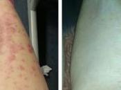 Psoriasis Client Case Study