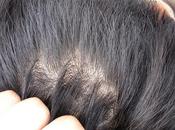 Simple, Quick Easy Tips Dandruff Permanently