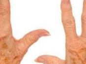 Most Effective Natural Ways Liver Spots Hands