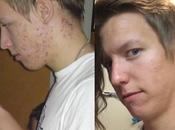 Acne (and IBS) Vanished with Diet Change